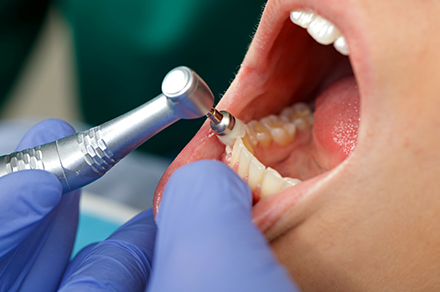むし歯・歯周病を予防するPMTC