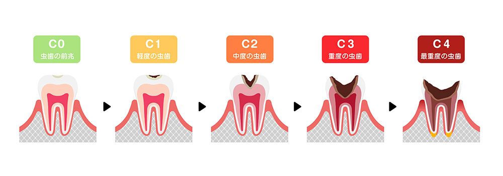 むし歯を放置せずに早めに治療をした方がいい理由