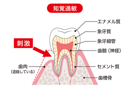 歯がしみる場合はむし歯以外の可能性もあります