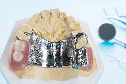 金属床義歯