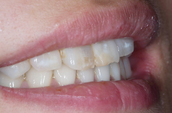 1：オールセラミック（e-max）で、白く、美しく、健康的な歯に