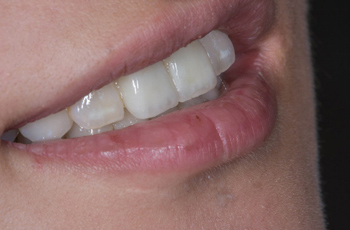 1：オールセラミック（e-max）で、白く、美しく、健康的な歯に