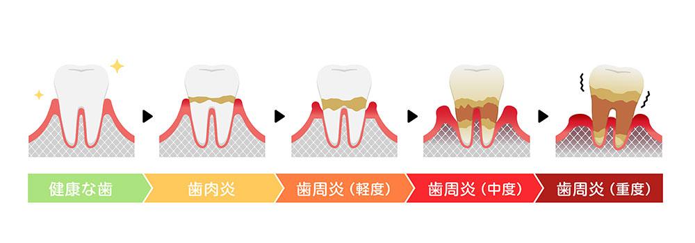 歯を失う原因第1位は歯周病です